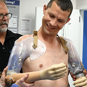 person using prosthetics arm